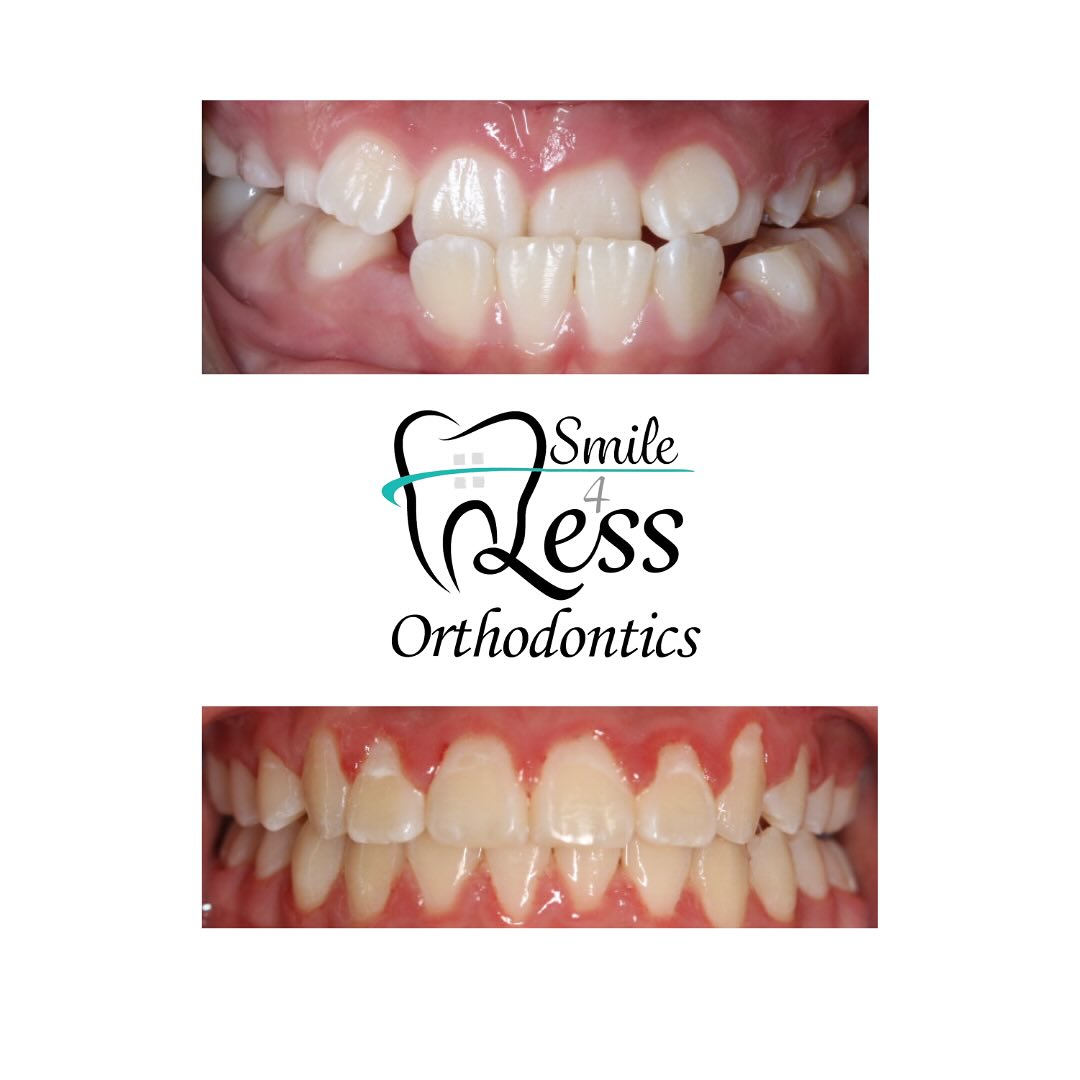 Before and after braces