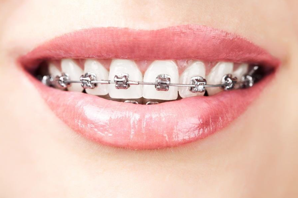 A beautiful smile with metallic braces A beautiful smile with metallic braces