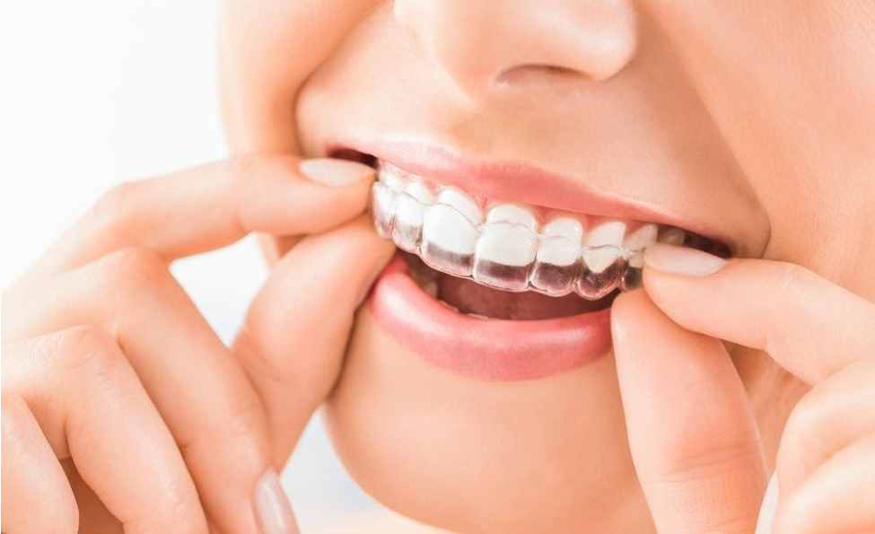 A beautiful smiling woman using Invisalign clear braces A beautiful smiling woman using Invisalign clear braces