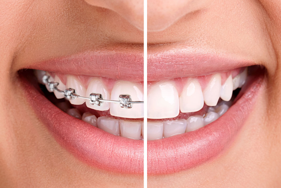 Clear braces vs traditional metallic braces Clear braces vs traditional metallic braces